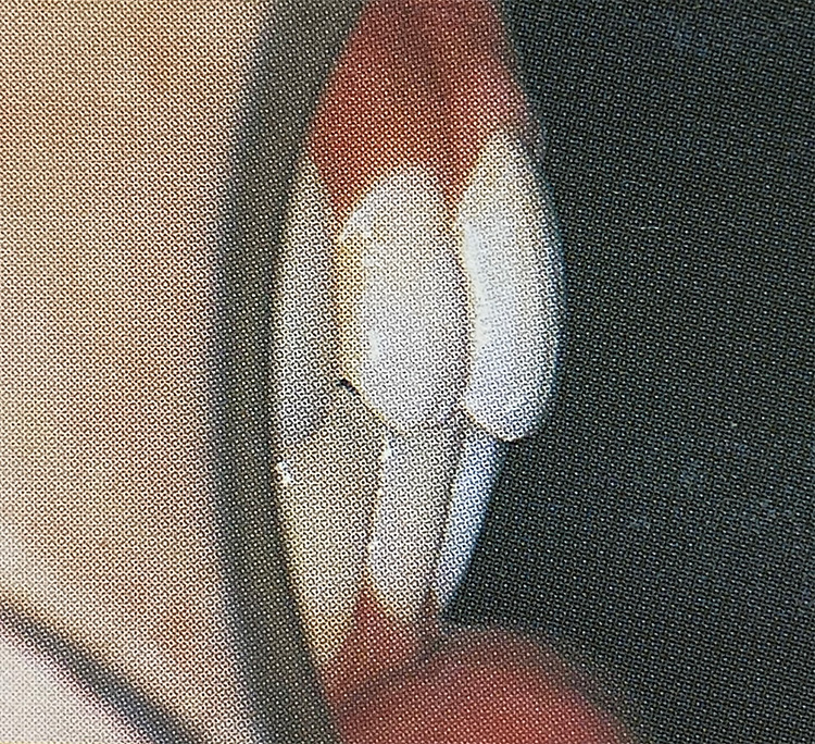 上顎前突(じょうがくぜんとつ)（出っ歯・口ゴボ）の施術後の写真