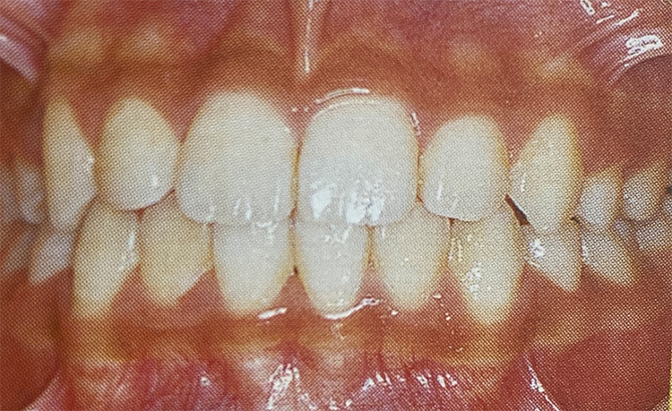 叢生(そうせい)（八重歯・乱抗歯）の施術後の写真