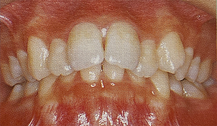上顎前突(じょうがくぜんとつ)（出っ歯・口ゴボ）の施術前の写真
