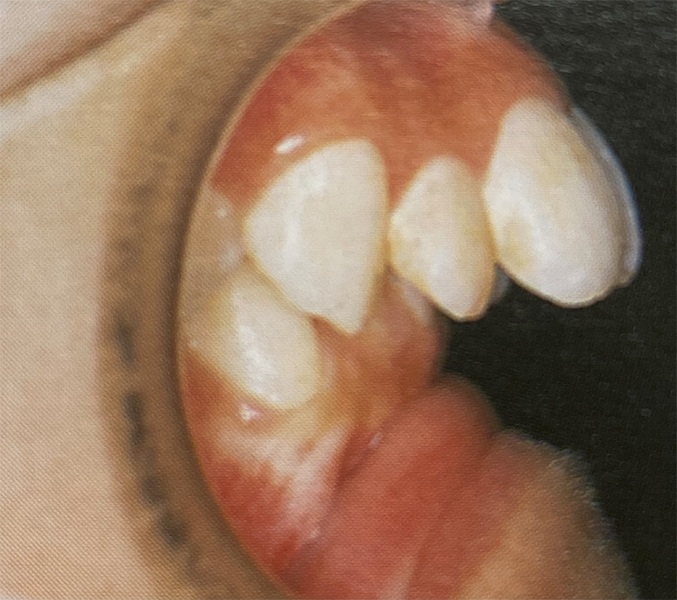 上顎前突(じょうがくぜんとつ)（出っ歯・口ゴボ）の施術前の写真