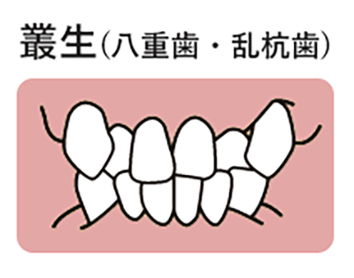 叢生(そうせい)（八重歯・乱抗歯）のイラスト