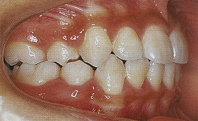 叢生(そうせい)（八重歯・乱抗歯）の施術後の写真