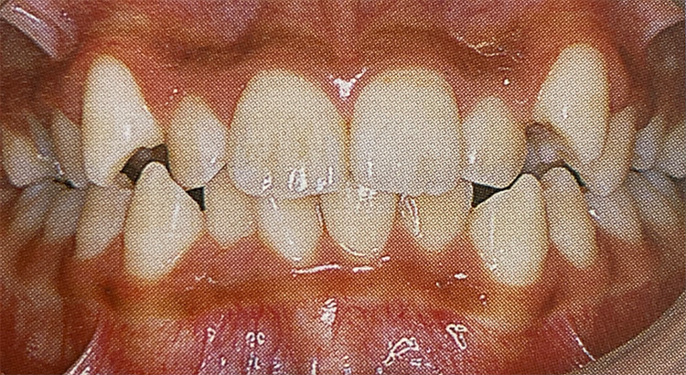 叢生(そうせい)（八重歯・乱抗歯）の施術前の写真