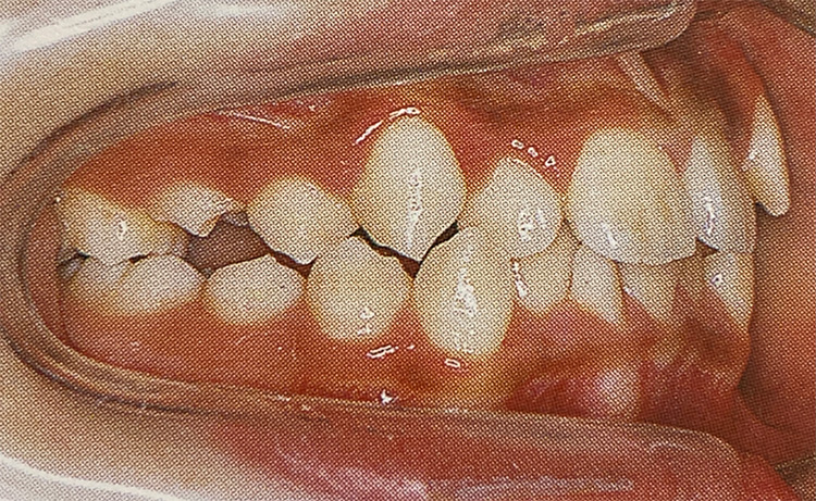 叢生(そうせい)（八重歯・乱抗歯）の施術前の写真